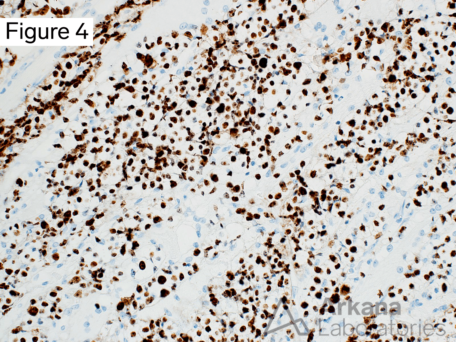 B-cell Lymphoma