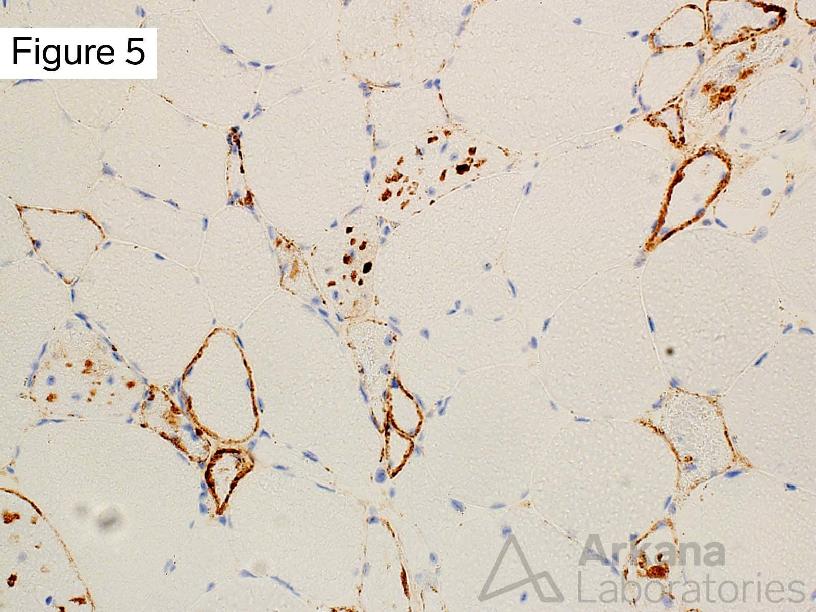 Vacuolar myopathy