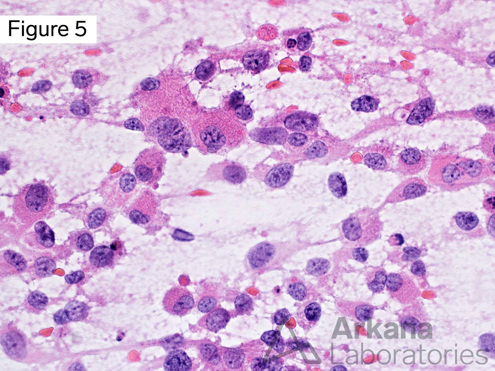 IDH-Wildtype Glioblastoma