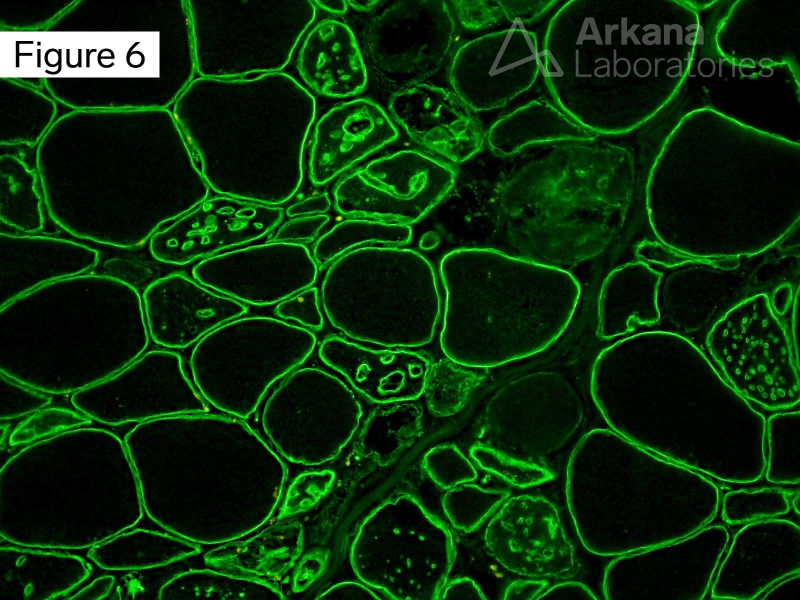 Vacuolar myopathy