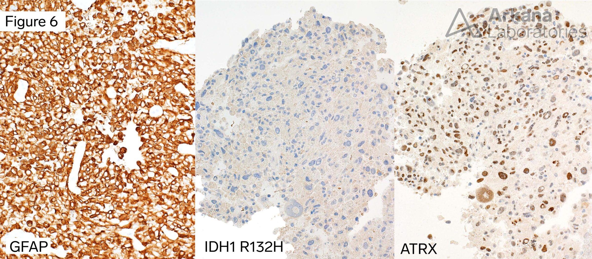 IDH-Wildtype Glioblastoma