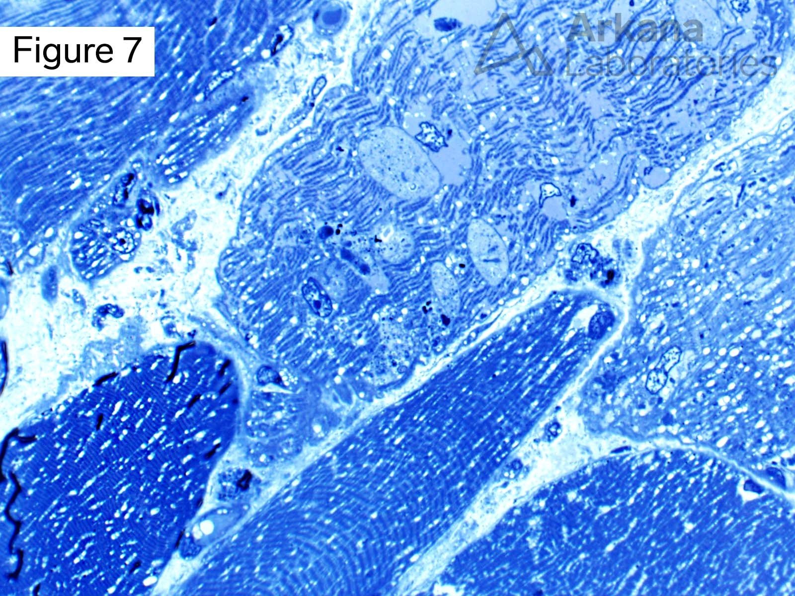 Vacuolar myopathy