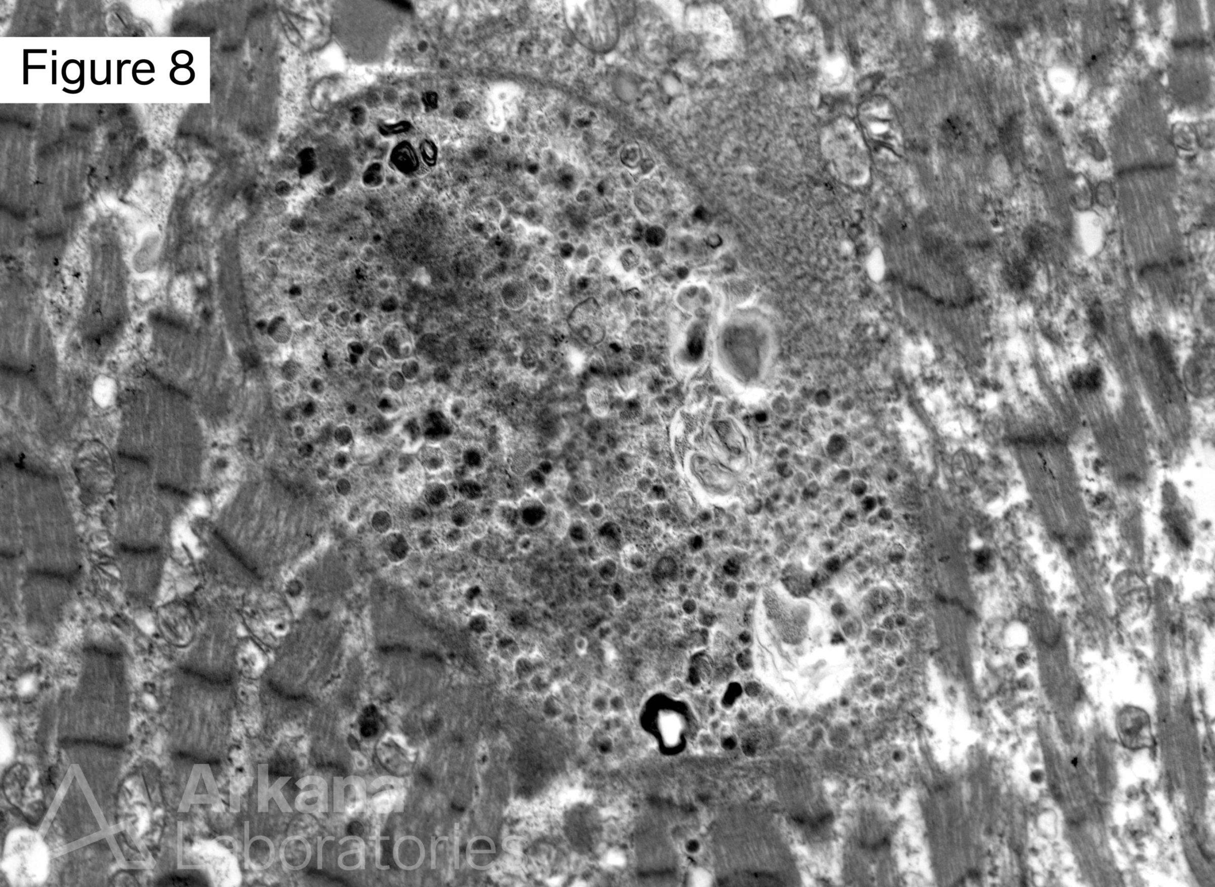 Vacuolar myopathy