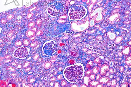 Focal and Segmental Glomerulosclerosis