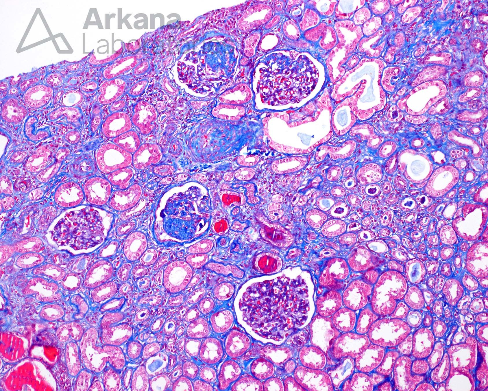 Focal and Segmental Glomerulosclerosis