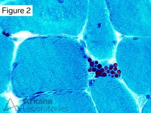 Russell Bodies on Gomori Trichrome Stain