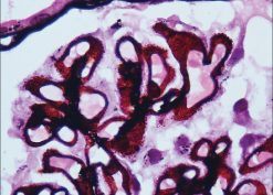 Membranous nephropathy as a rare renal manifestation of IgG4-related disease