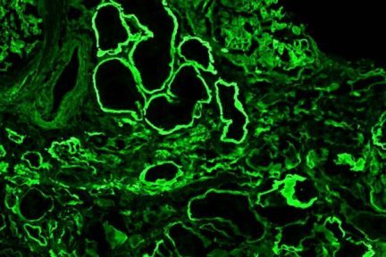 IgG, Anti-TBM Interstitial Nephritis