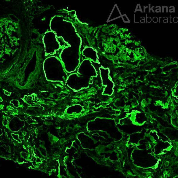 IgG, Anti-TBM Interstitial Nephritis