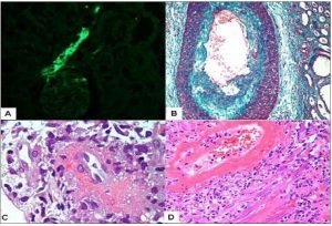 kidney pathology, lupus nephritis, lupus disease week, arkana laboratories