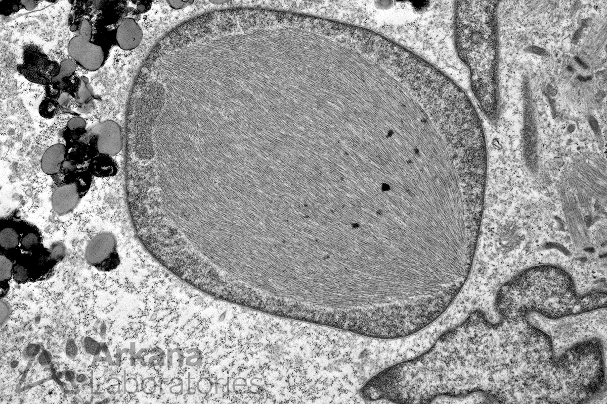 Inclusion Body Myositis