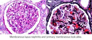 lupus nephritis disease week, arkana laboratories, renal diseases, LN
