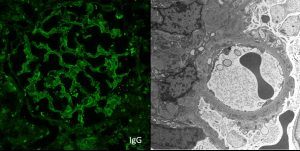 lupus nephritis disease week, arkana laboratories, renal diseases, LN