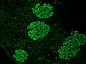LUPUS NEPHRITIS, SLE, SYSTEMIC LUPUS ERYTHEMATOSUS