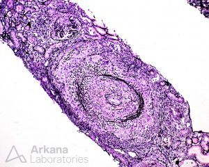 ANCA-associated Vasculitis (AAV), Disease week, arkana laboratories