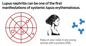 LUPUS NEPHRITIS, SLE, SYSTEMIC LUPUS ERYTHEMATOSUS