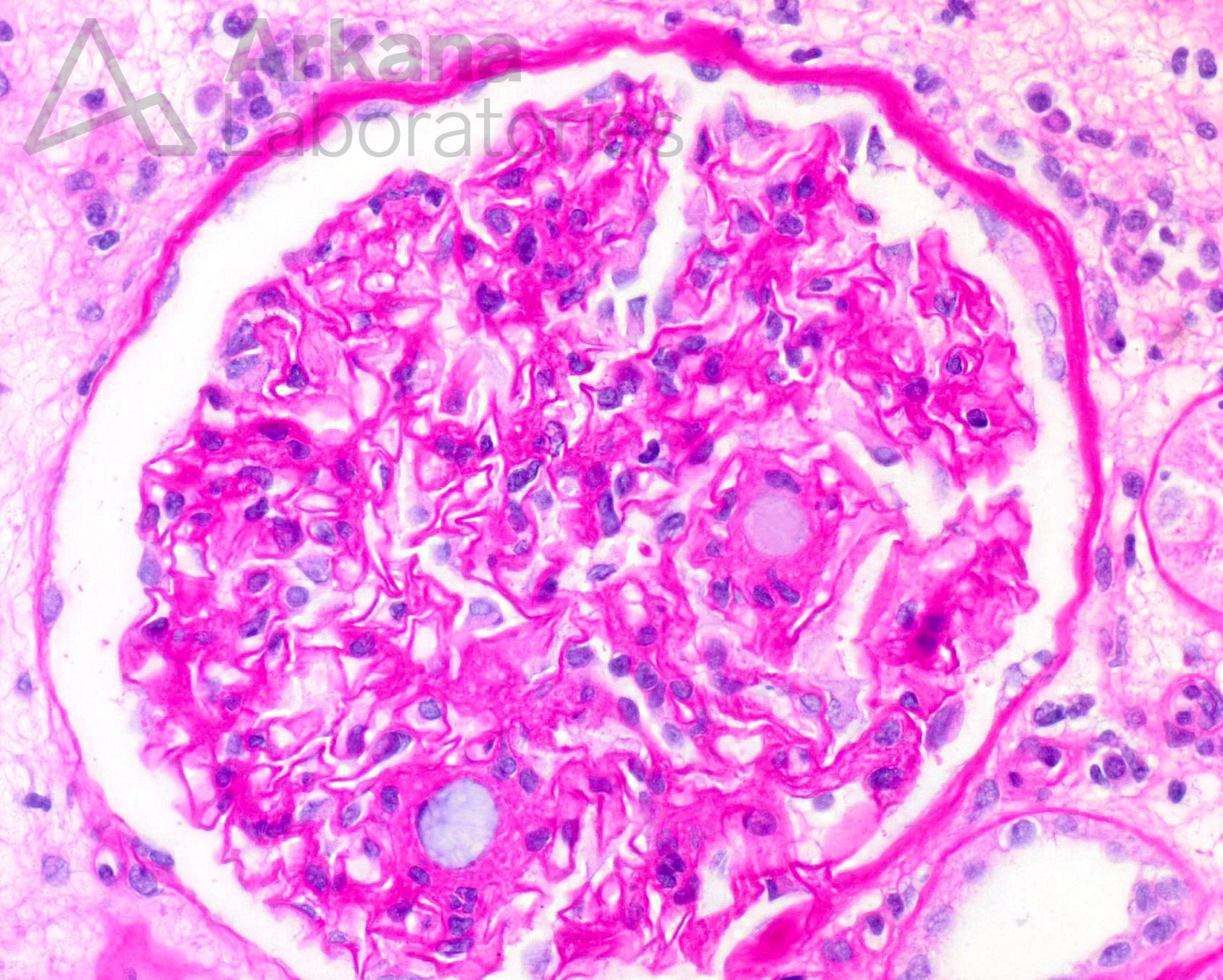 polymer emboli, gray and basophilic amorphous material, glomerular capillaries