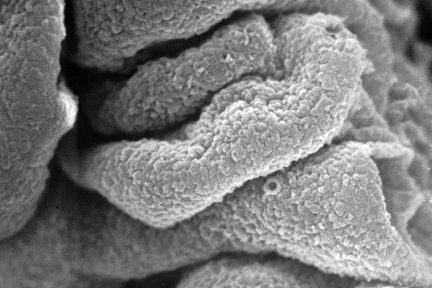 Subepithelial Immune Deposits