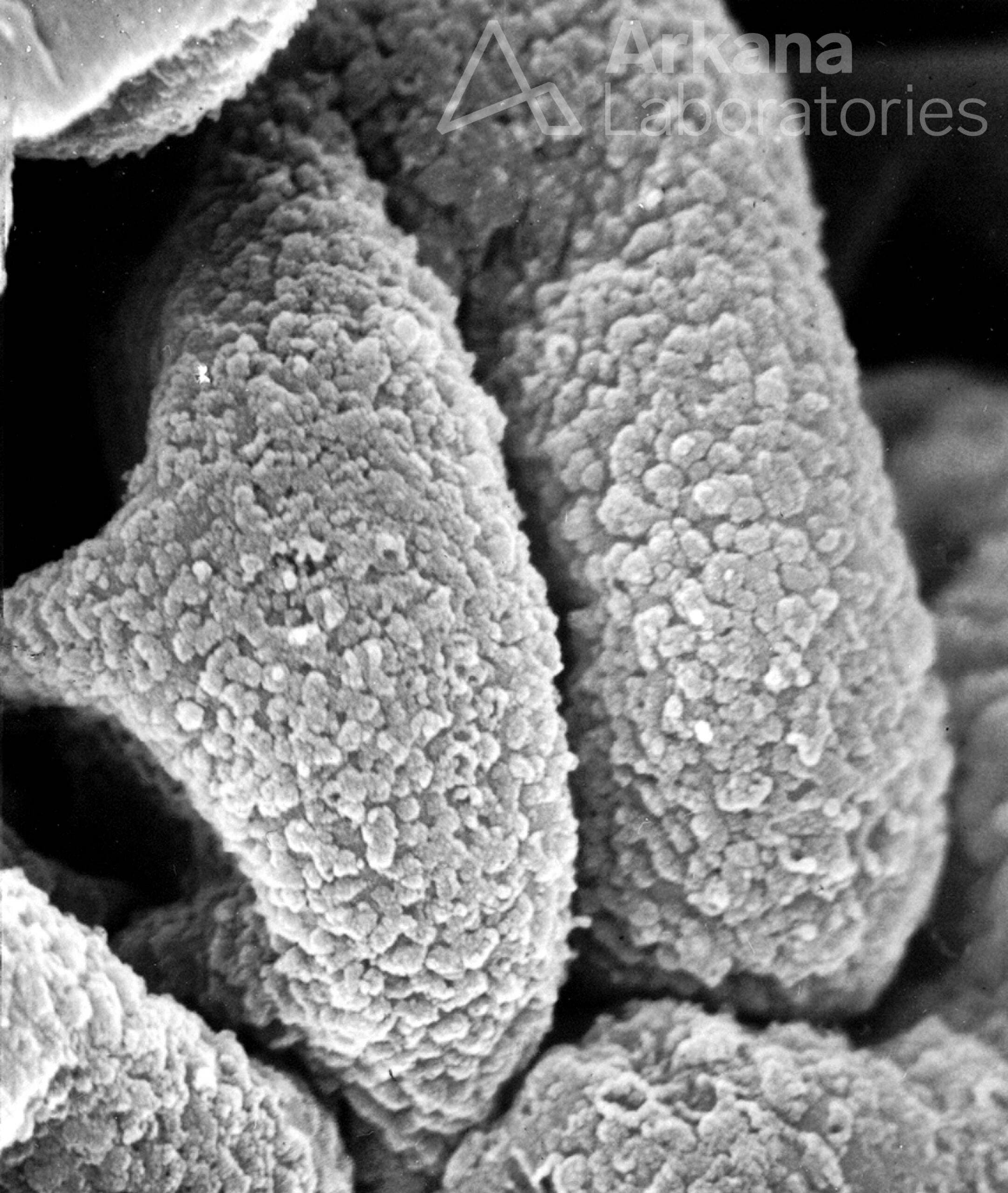 Subepithelial Immune Deposits