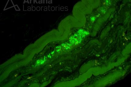 Thioflavin T stain showing fibrillary inclusions