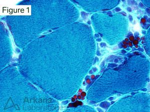 Russell Bodies on Gomori Trichrome Stain