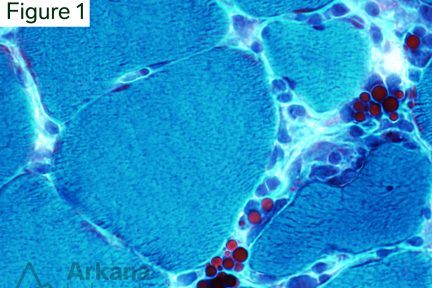 Russell Bodies on Gomori Trichrome Stain