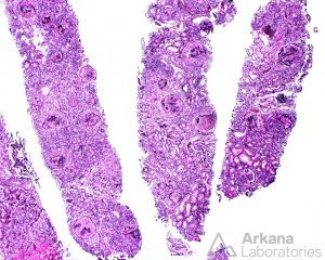 ANCA-associated Vasculitis (AAV), Disease week, arkana laboratories