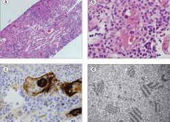 Late presentation of adenovirus-induced hemorrhagic cystitis and ureteral obstruction in a kidney-pancreas transplant recipient