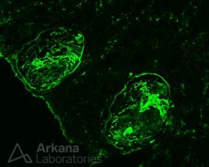 ANCA-associated Vasculitis (AAV), Disease week, arkana laboratories