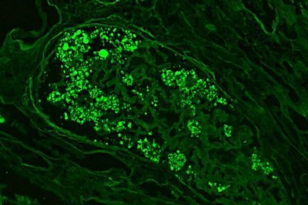 collapsing glomerulopathy in APOL1