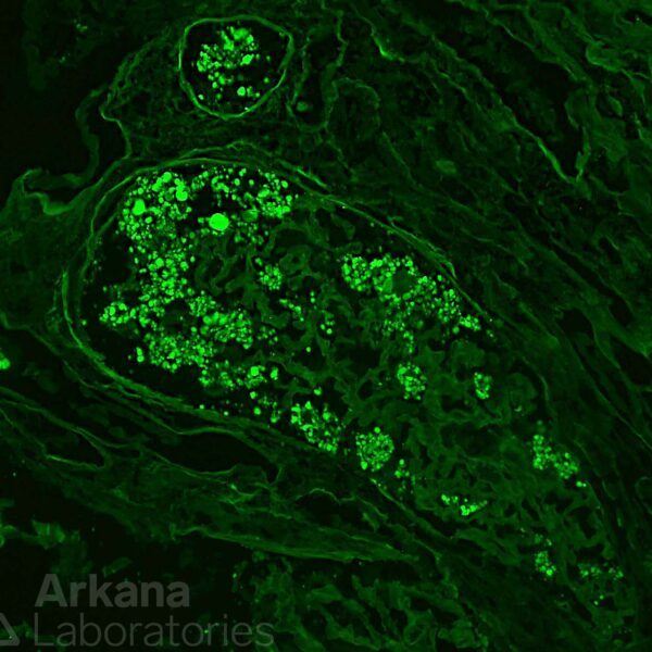 collapsing glomerulopathy in APOL1