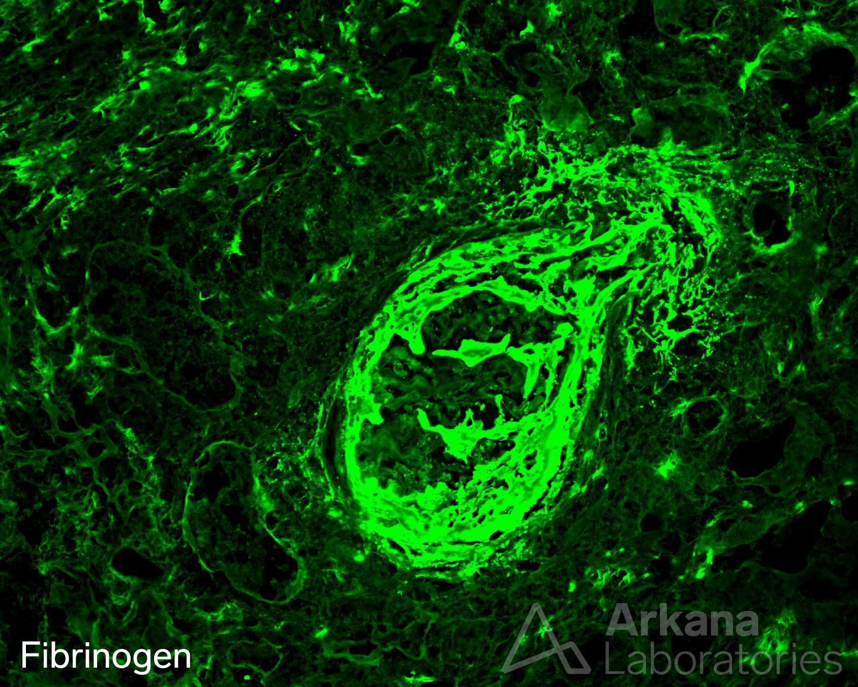 fibrinoid necrosis and crescent formation