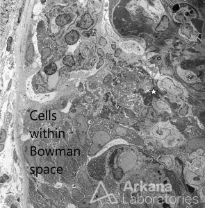 ANCA-associated Vasculitis (AAV), Disease week, arkana laboratories