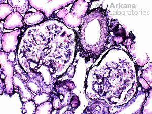 ANCA-associated Vasculitis (AAV), Disease week, arkana laboratories