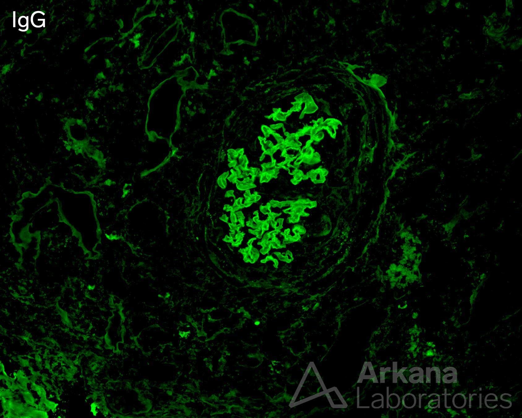 fibrinoid necrosis and crescent formation