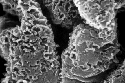 membranous glomerulonephritis, stage III