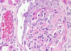 vasculitis classification