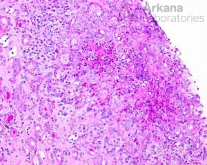 ANCA-associated Vasculitis (AAV), Disease week, arkana laboratories