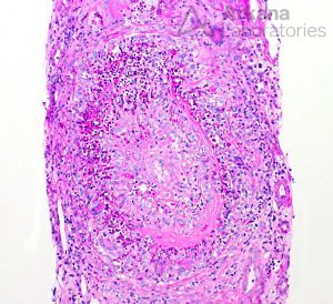 ANCA-associated Vasculitis (AAV), Disease week, arkana laboratories