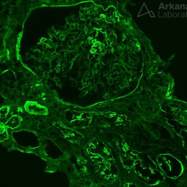 anti-brush border antibody disease