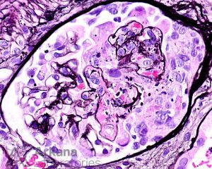 ANCA-associated Vasculitis (AAV), Disease week, arkana laboratories