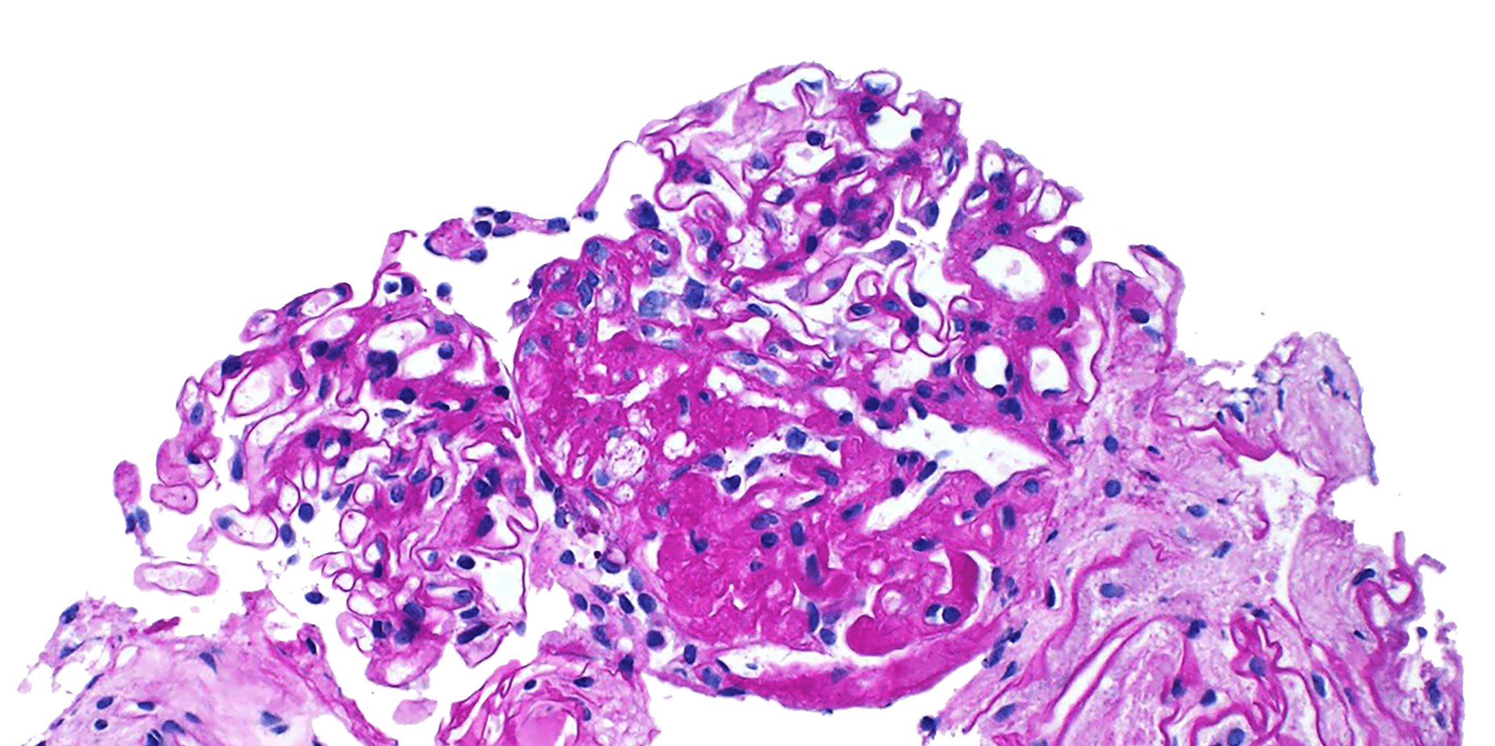 diagnostic image of a renal biopsy sent to arkana laboratories showing glomerulus