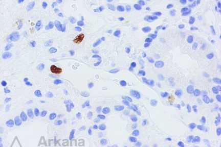 cmv pneumonia