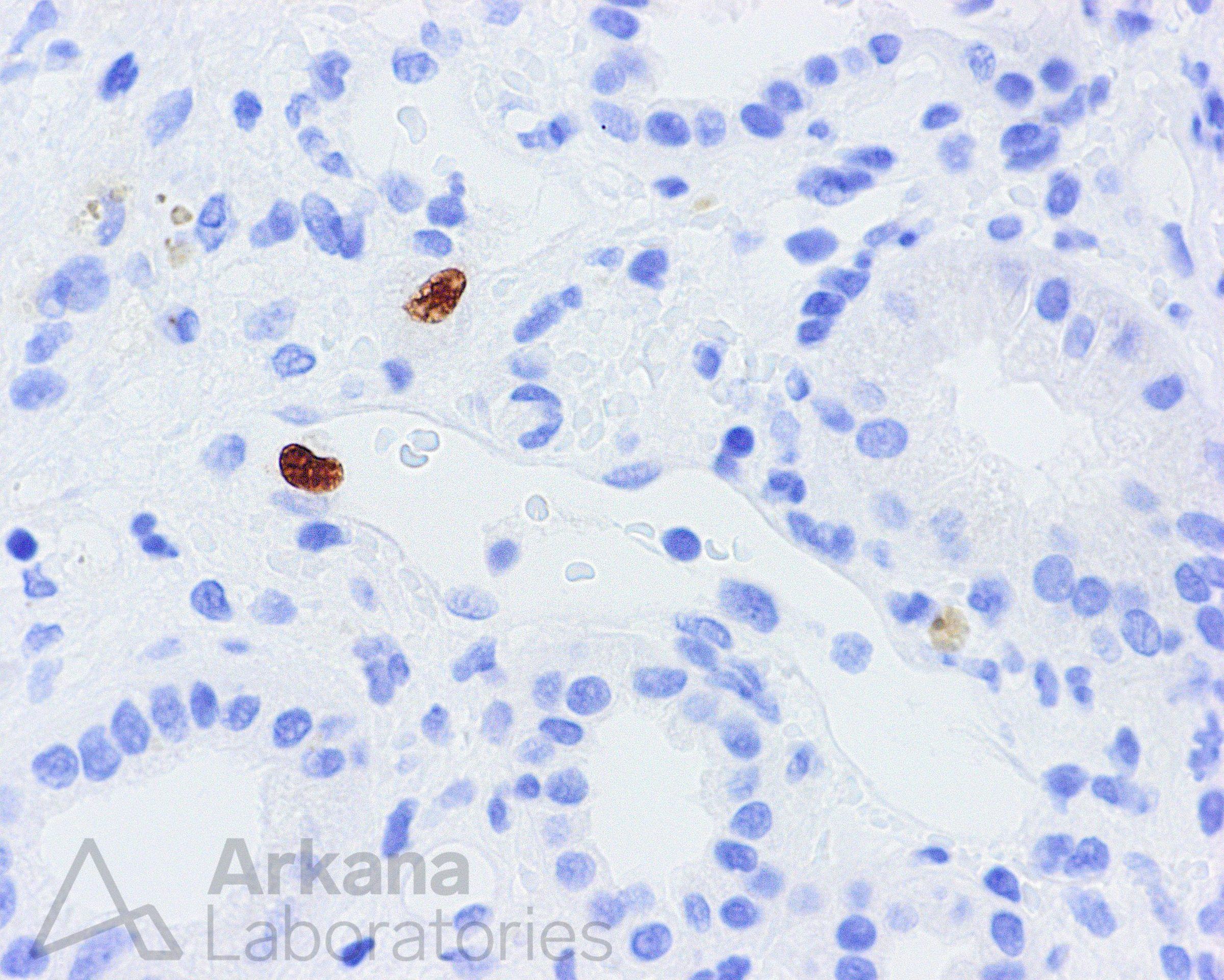 cmv pneumonia