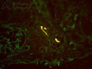 Cholesterol Arterial Emboli