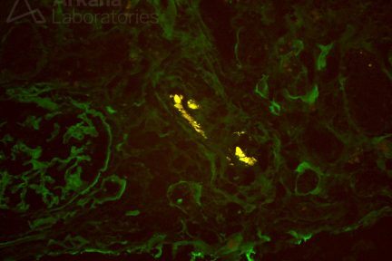 Cholesterol Arterial Emboli