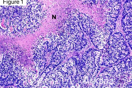 ADENOCARCINOMA, FETAL LUNG, METASTASIS, SUBNUCLEAR