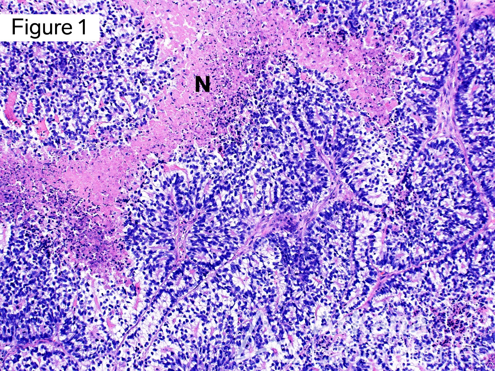 ADENOCARCINOMA, FETAL LUNG, METASTASIS, SUBNUCLEAR