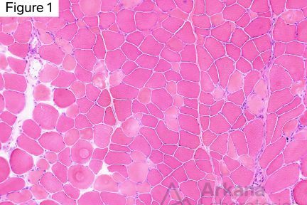 Toxic Myopathy Due to Ingestion of Palytoxin, Low magnification image showing frequent scattered pale staining muscle fibers which have lost their nuclear staining for hematoxylin