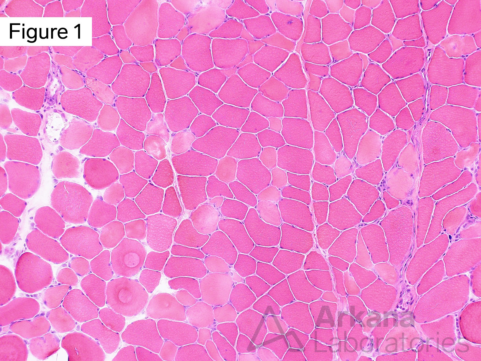 Toxic Myopathy Due to Ingestion of Palytoxin, Low magnification image showing frequent scattered pale staining muscle fibers which have lost their nuclear staining for hematoxylin